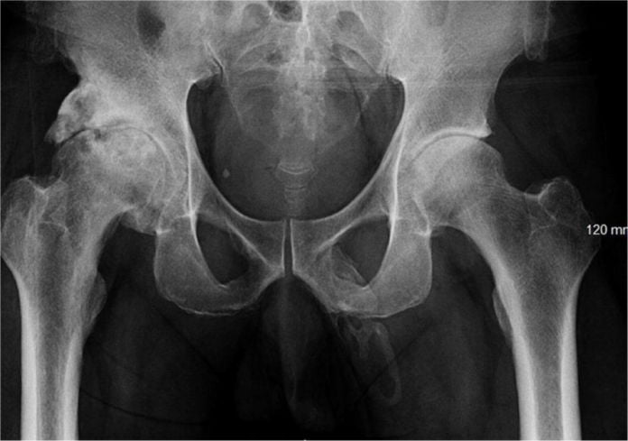 Una radiografía de rutina revela que a este hombre el pene se le está convirtiendo en un hueso