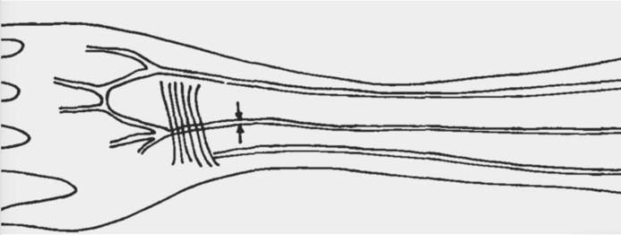 arteria mediana