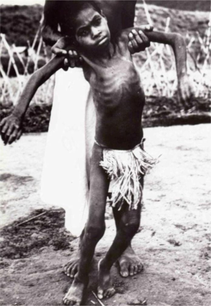 pueblo Fore de Papua Nueva Guinea - Diez casos reales de canibalismo humano