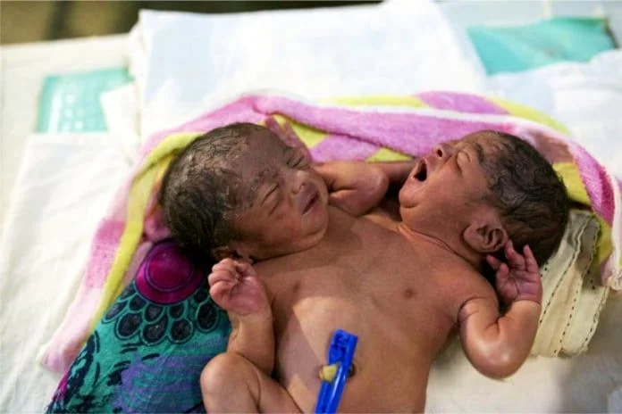 Cómo es realmente la vida de los siameses, los gemelos que nacen con sus cuerpos unidos