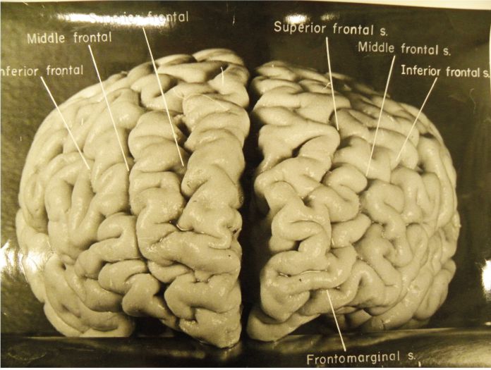 cerebro de Albert Einstein