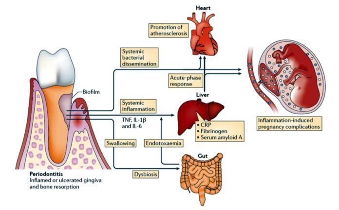 periodontitis