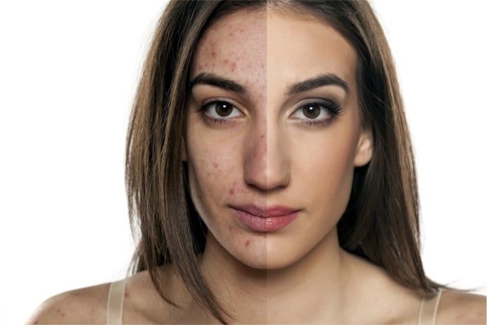 El Ácido Salicílico puede ayudar a combatir el acné y mejorar su aspecto