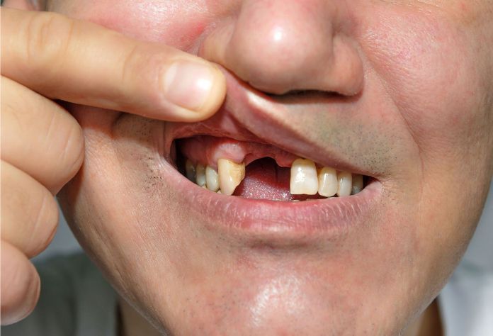 Inflamación de encías y pérdida de dientes