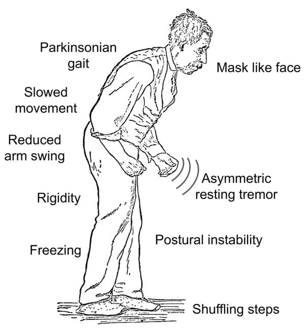 Los síntomas relacionados con el movimiento de la enfermedad de Parkinson