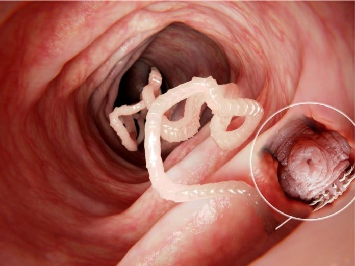 neurocisticercosis