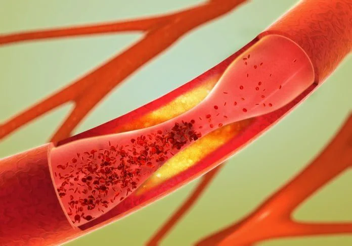 Estrechamiento de los vasos sanguíneos
