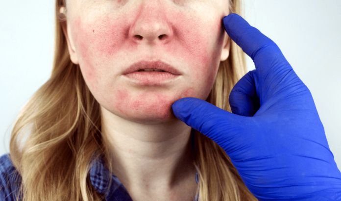 Tipos de dermatitis y sus tratamientos